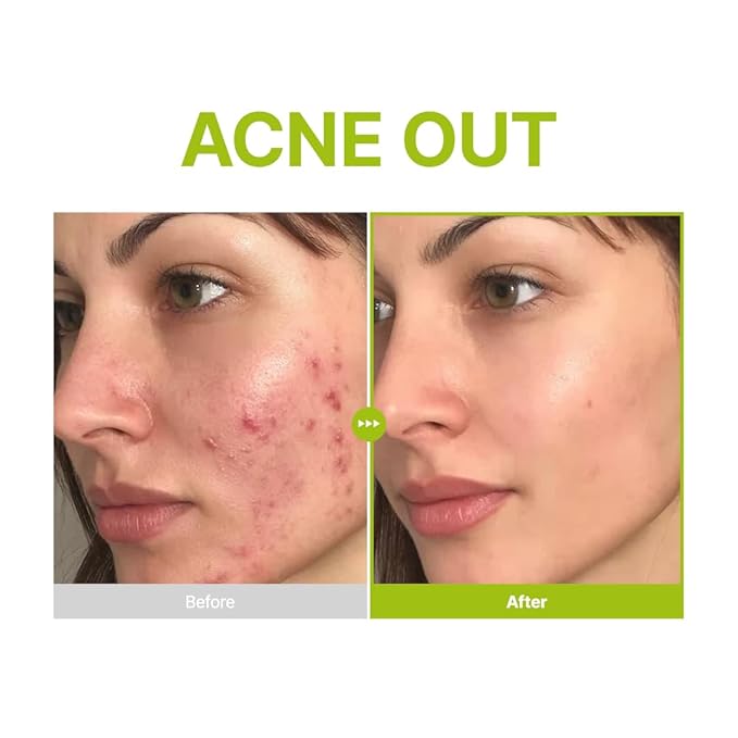 PURITO Azelaic 10% + Kojic Serum | Blemish Care, Redness Relief 1.01 Fl.oz
