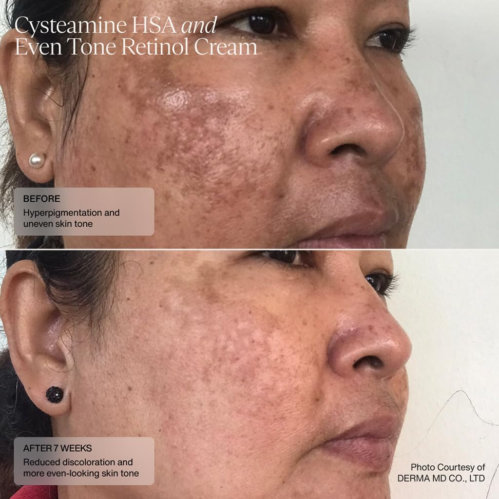 Senté Even Tone Retinol Cream | 0.5% Retinol Combined with HSA & Skin-Firming DSA | Improves Skin Tone, Texture, & Dark Spots | 1.0 Fl Oz