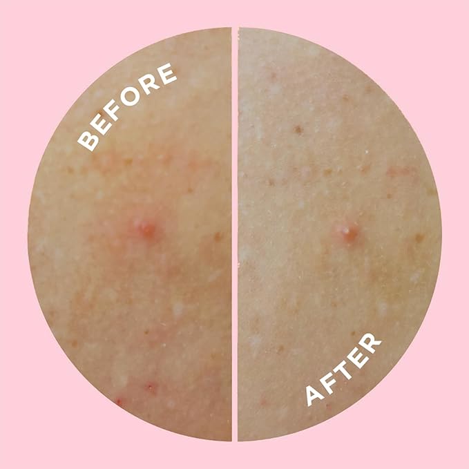 ZitSticka Large Pimple Patches for Face and Body, Goo Getter Hydrocolloid Patches to Cover Zits & Blemishes, Acne Patches or Zit Spot Stickers, Blemish Patch (Body Patch 9 Pack)