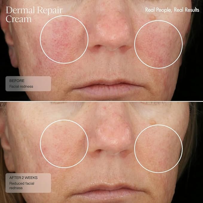 Senté Dermal Repair Facial Cream | Nourishing for Rosacea, Sensitive Skin, & Post-Procedure | Hydrate & Soothe| with Patented HSA, Vitamin E & Green Tea Extract | 1.7 Fl Oz
