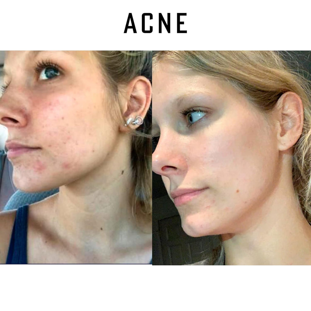 Simply O3 Pure Organic Ozonated Olive Oil Extra Strength 1200 Peroxide For Face and Skin Helps In Acne, Anti-Aging, Wrinkles and Rosacea For Sensitive Skin Made in Spain