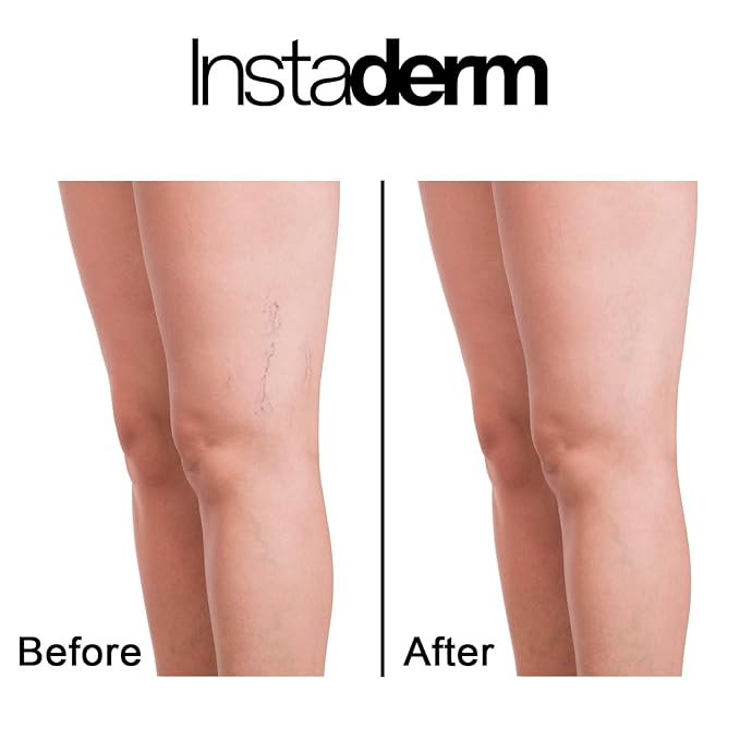 Vitamin K Cream-Revitalizing Formula with Arnica for the Appearance of Brusing, Spider Veins, Broken Capillaries, Uneven Tone & Dark Spot – Under Eye Cream for the Look of Dark Circles & Puffiness