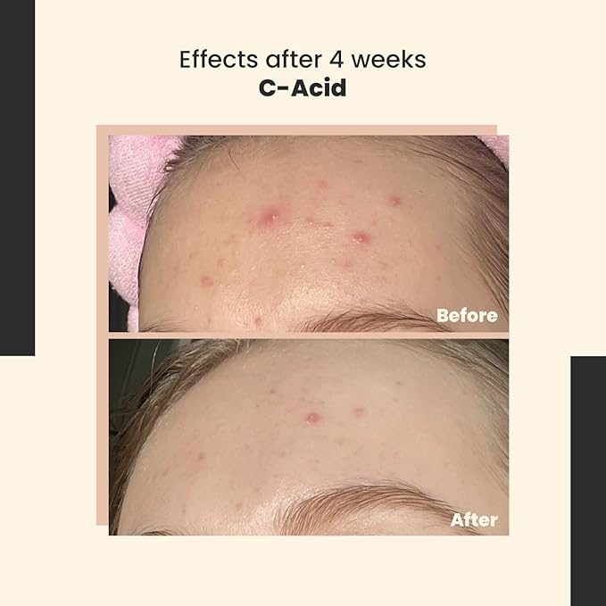 SkinTra C-Acid Vitamin C & AHA Face Serum – Advanced Exfoliating and Brightening Treatment – Designed for Night Use with Lightweight Finish – 10% AHA Blend – 30 ml/Net 1.01 Fl. Oz