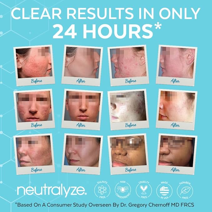 Neutralyze Acne Pads with DuoClear Acid System — 1% Salicylic + 1% Mandelic Dual-Textured Exfoliating Toner Pads for Face, Back & Body — Fragrance-Free, Low-Alcohol — Step 2 (100 ct)