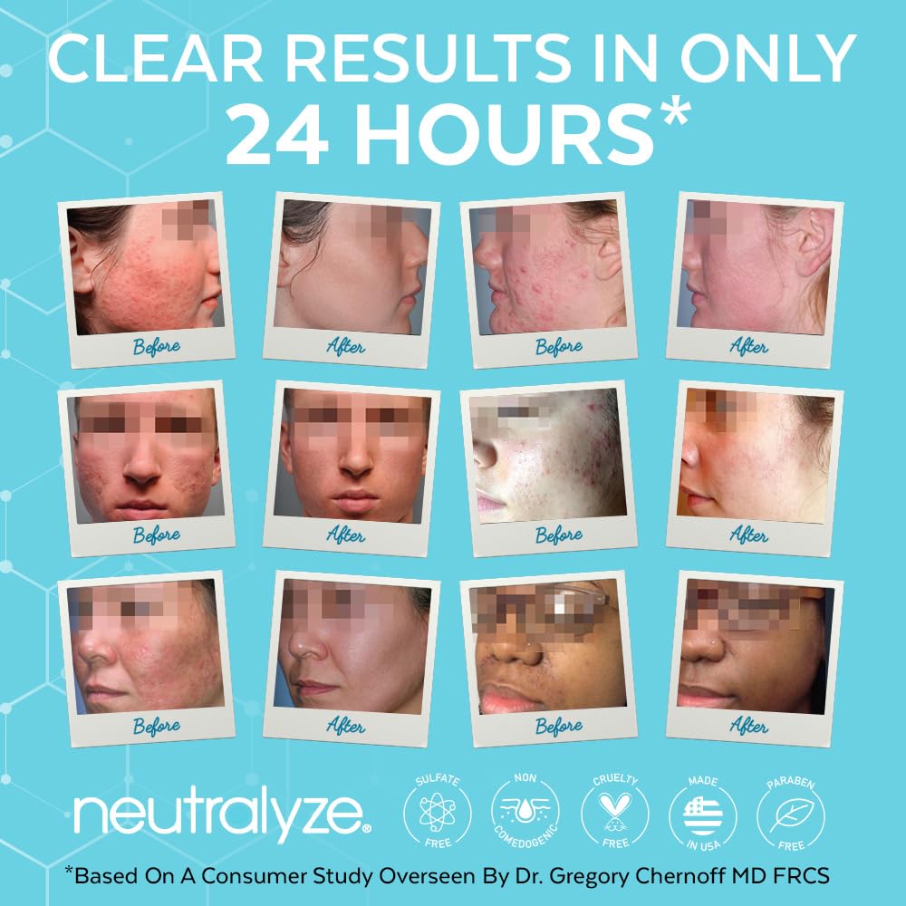 Neutralyze Acne Pads with 1% Salicylic + 1% Mandelic, 100 Count