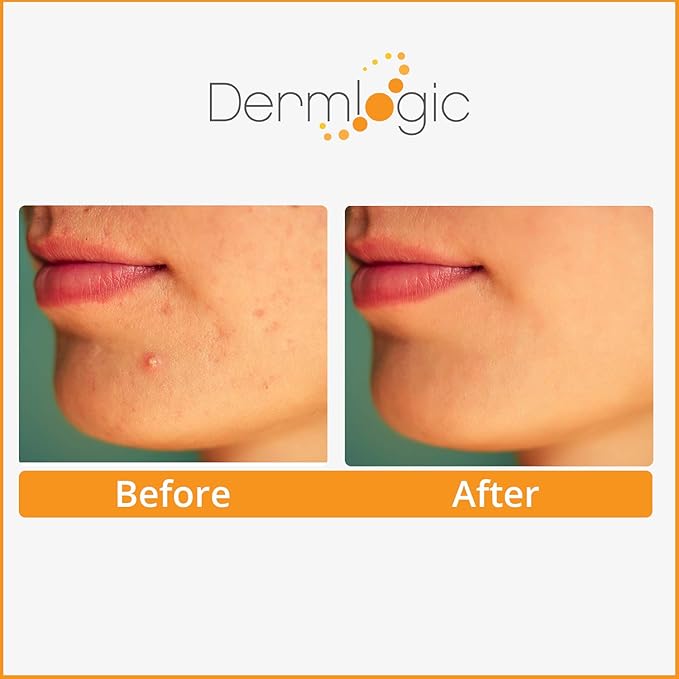 Dermlogic Acne Treatment Pads-Contains Glycolic, Lactic, Salicylic Acid. Eliminates Oily Skin, Clogged Pores & Cystic Breakouts. Removes Dark Spots, Whitehead & Blackhead Pimples for Face & Body.