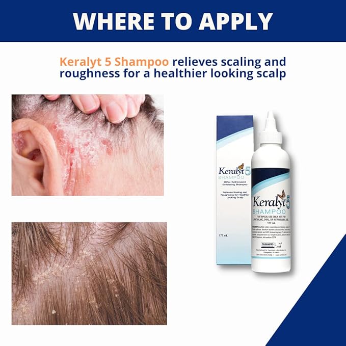 Keralyt 5 Anti-Dandruff Shampoo - Max Strength 5% Salicylic Acid Scalp Build-Up Clearing - Promotes Relief from Dandruff, Psoriasis, Seborrheic Dermatitis, Dryness, and Itchiness, 177 milliliters