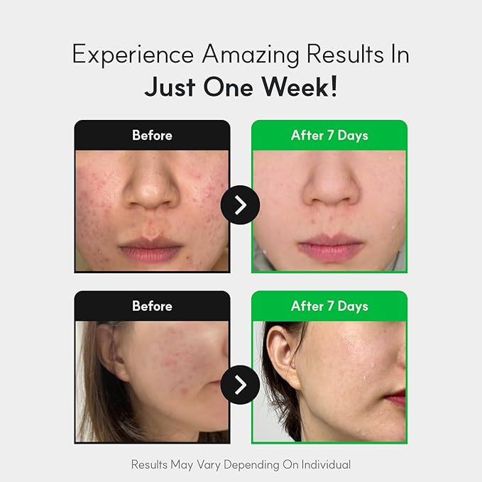 NEUL20S Centelsome 5X Soothing Serum 1.69 fl oz/50ml | for Hydration, Glow, Sensitive, Anti Aging, Acne treatment for Face, Korean Skincare with Centella Asiatica, Exosomes for Skin, Panthenol