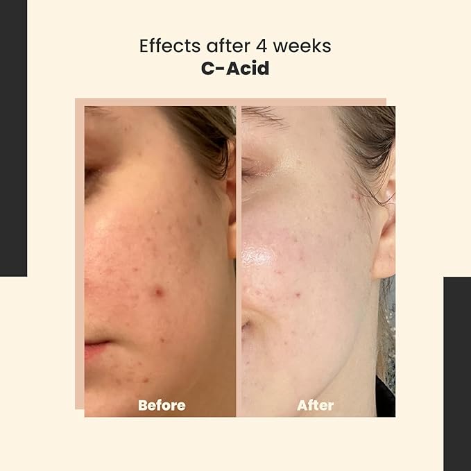 SkinTra C-Acid Vitamin C & AHA Face Serum – Advanced Exfoliating and Brightening Treatment – Designed for Night Use with Lightweight Finish – 10% AHA Blend – 30 ml/Net 1.01 Fl. Oz