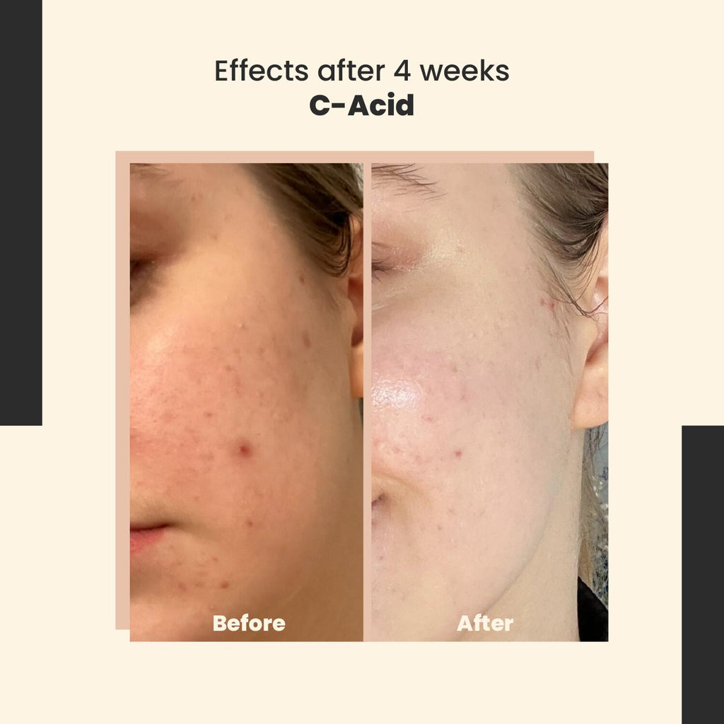 SkinTra C-Acid Vitamin C & AHA Face Serum – Advanced Exfoliating and Brightening Treatment – Designed for Night Use with Lightweight Finish – 10% AHA Blend – 30 ml/Net 1.01 Fl. Oz