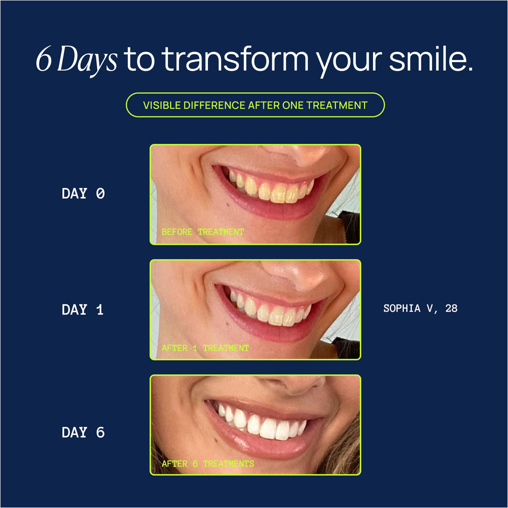 Laughland Super Strength Teeth Whitening Gel 3 Pack, Tooth Whitener, 11% Hydrogen Peroxide, Glycerin, Aloe Vera & Mint, At Home Dental Care, Travel Friendly, 6 Treatments