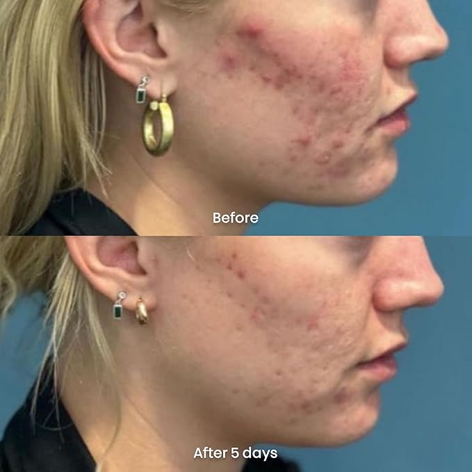 ORBE Derma Solutions Orbe it! 2-Step Acne Treatment w/ Salicylic Acid for Face & Body – Helps Unclog Pores & Reduce Pimples, Back Acne, Ingrown Hairs, Razor Bumps, Folliculitis – Spray 1oz & Cream 1oz