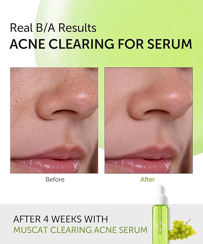 SERUMKIND Muscat Clearing Drop Serum, Blemish, Breakout & Pore Care with Shine Muscat & PHA, Gentle Exfoliation & Brightening, Korean Skincare (1.01 fl oz / 30 ml)