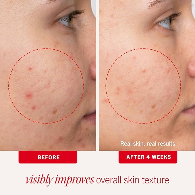 First Aid Beauty Acne Treatment Pads, 2% Salicylic Acid, 60 ct