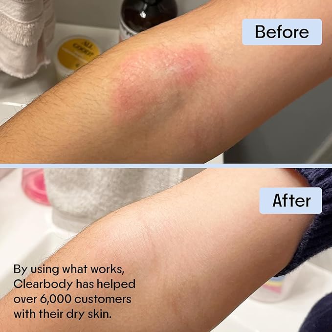 Clearbody Organics Manuka Honey Gel Cream for Eczema (2 fl oz)