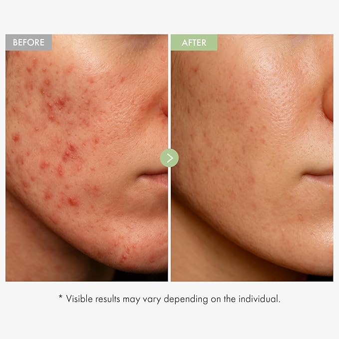 TOSOWOONG Exosome CICA Face Cream for Redness & Blemish-Prone Skin, Calming