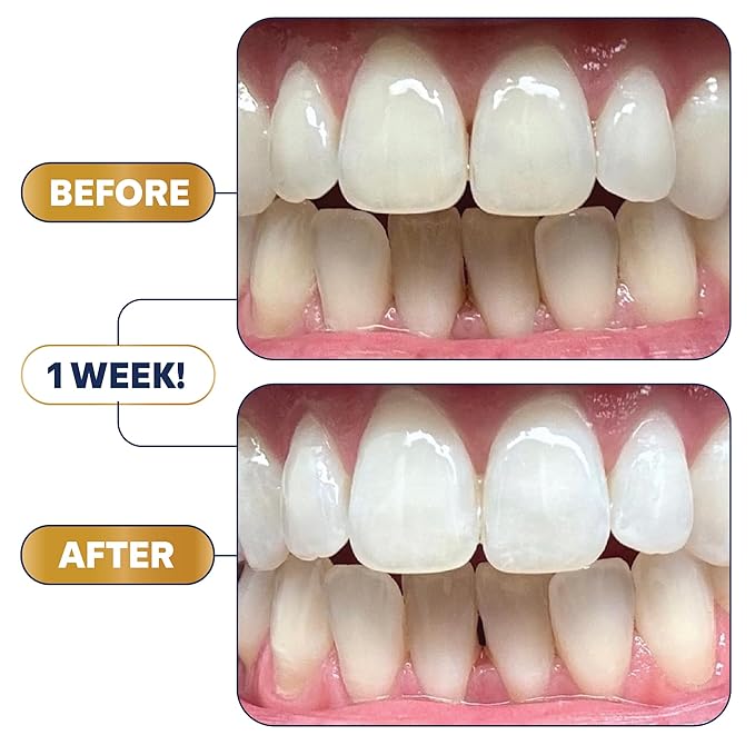 Lumineux 2-in-1 Teeth Whitening Pen, Removes Coffee & Tea Stains