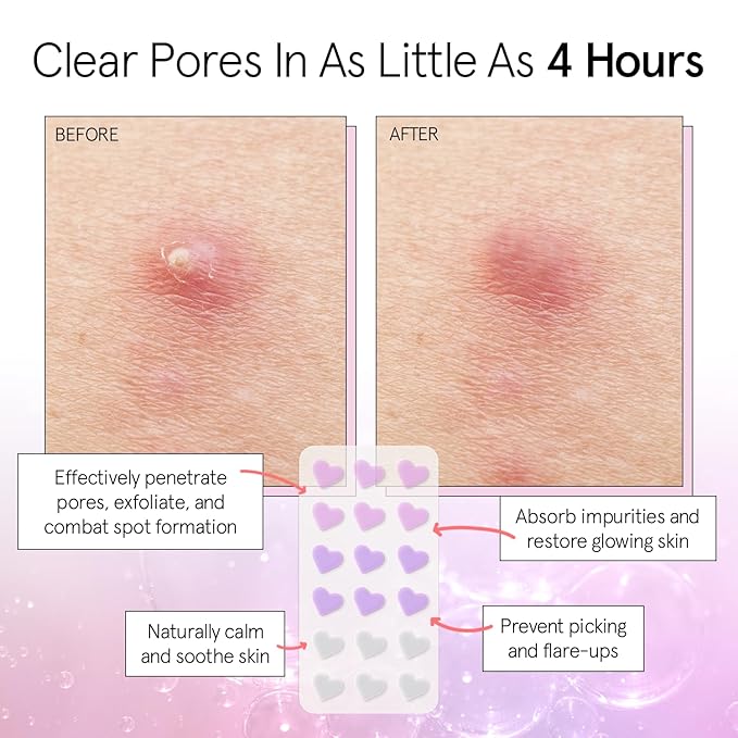 grace & stella Award Winning Pimple Patches for Face - Dermatologist Tested Acne Patches - Hydrocolloid Patch for Breakouts, Whiteheads - Vegan Acne Spot Treatment for Face (Heart, 144 Count)