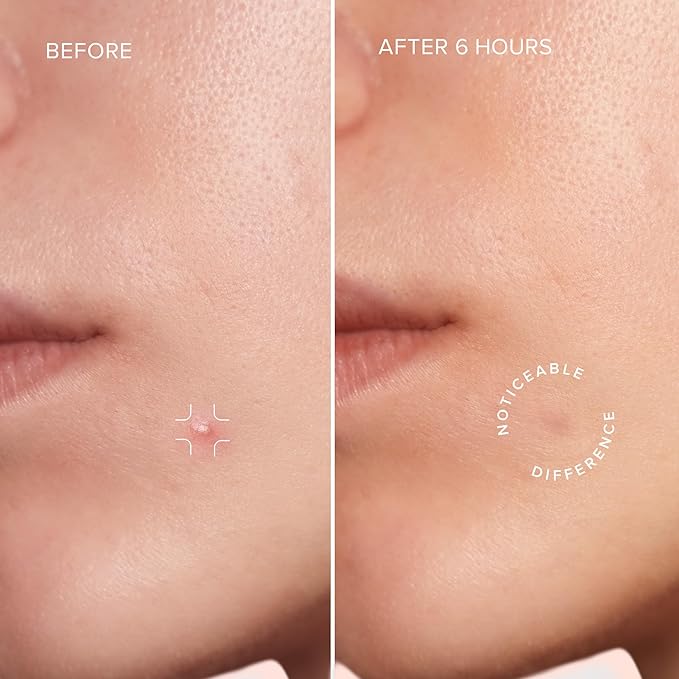 MAREE Star Pimple Patches for Face - Hydrocolloid Acne Patches w/Salicylic Acid, Tea Tree Oil & Centella - Cute Pimple Patches Stars - Teens Zit Patches Stickers - Parches Para Acne - 72 Blemish Dots