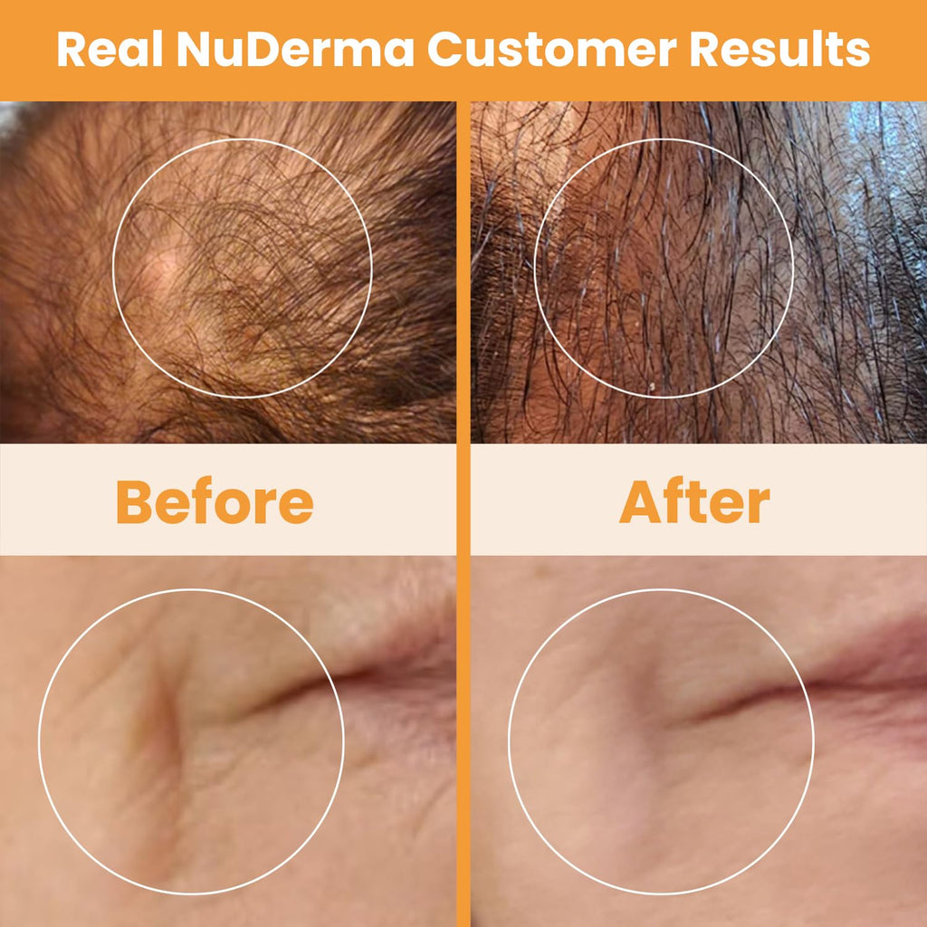 Pure Daily Care NuDerma Handheld Skin Therapy Wand Machine w/Neon – Anti-Aging - Skin Tightening - Wrinkle Reducing - Dark Circles – Clarifying - Hair & Scalp Stimulator
