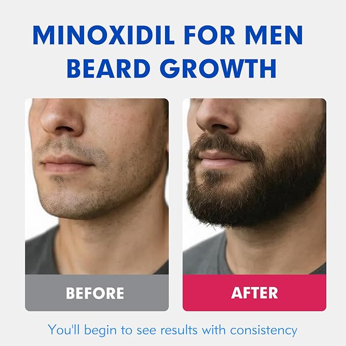 Fytikal 5% Minoxidil for Men Hair Regrowth Treatment, Extra Strength Topical Solution for Thinning Hair & Balding, Beard Growth Enhancer, Non-Greasy Fast-Absorbing Formula, 3-Month Supply