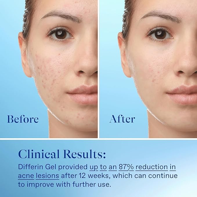 Differin Acne Retinoid Treatment Gel, 0.1% Adapalene, 15g Tube, 2ct