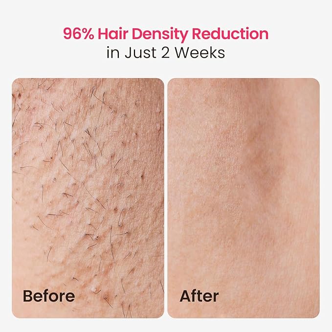 IPL Laser Hair Removal for Women and Men, 25J Triple-Pulse Permanent Hair Removal Device for Ingrown Hair, 37°F Painless Sapphire Ice Cooling Hair Removal for Legs, Armpits, Face, Bikini, Underarms