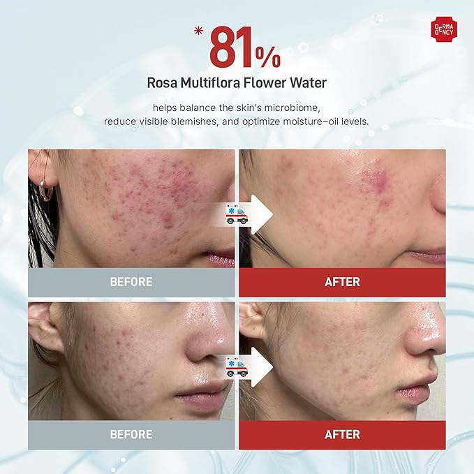 DERMAGENCY Zeroca 81 Cream | Korean Acne Cream for Sensitive & Oily Skin | Lightweight, Non-Greasy, Calming Hydration | Oil Control, Pore Refining, Cica | Fragrance-Free | K-beauty 2.02 Fl.Oz / 60ml