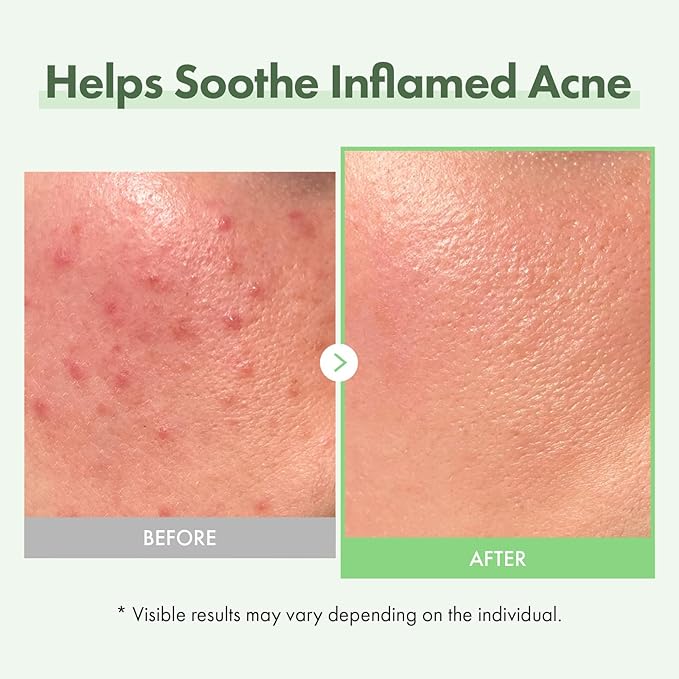TOSOWOONG Azelaic Acid 10% Face Serum for Redness & Blemish, Rosacea, Glow