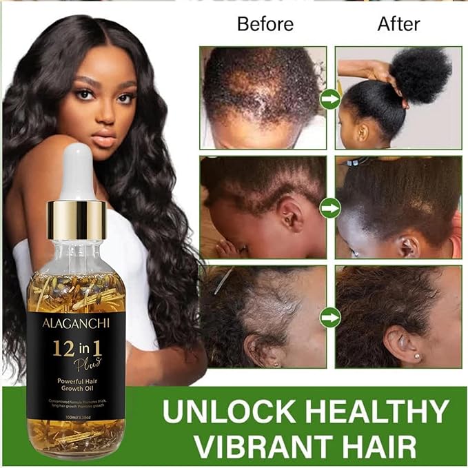 Alaganchi 12-in-1 Hair Growth Oil – Rosemary, Amla & Castor Oil | Strengthens, Nourishes, Reduces Hair Fall | Natural Herbal Blend | Non-Greasy | Paraben & Sulfate-Free