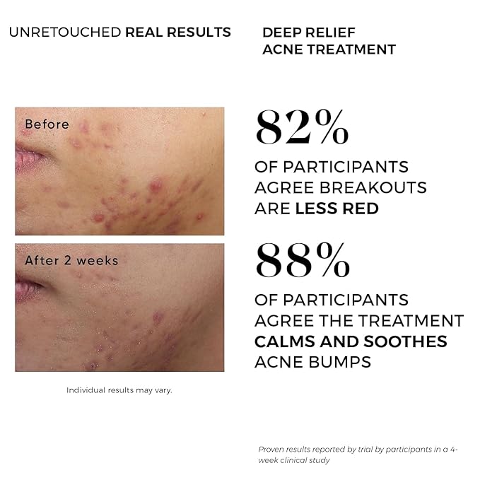 Dermlogic Acne Treatment Pads-Contains Glycolic, Lactic, Salicylic Acid. Eliminates Oily Skin, Clogged Pores & Cystic Breakouts. Removes Dark Spots, Whitehead & Blackhead Pimples for Face & Body.