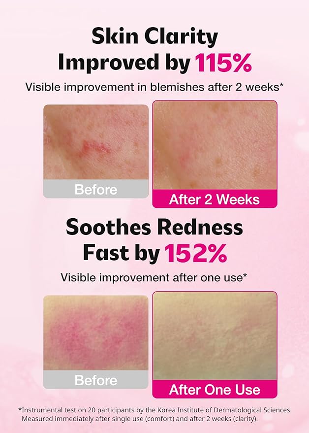 ISOI Blemish Care Up Serum with Arbutin & Rose Otto Oil, 0.85 fl oz