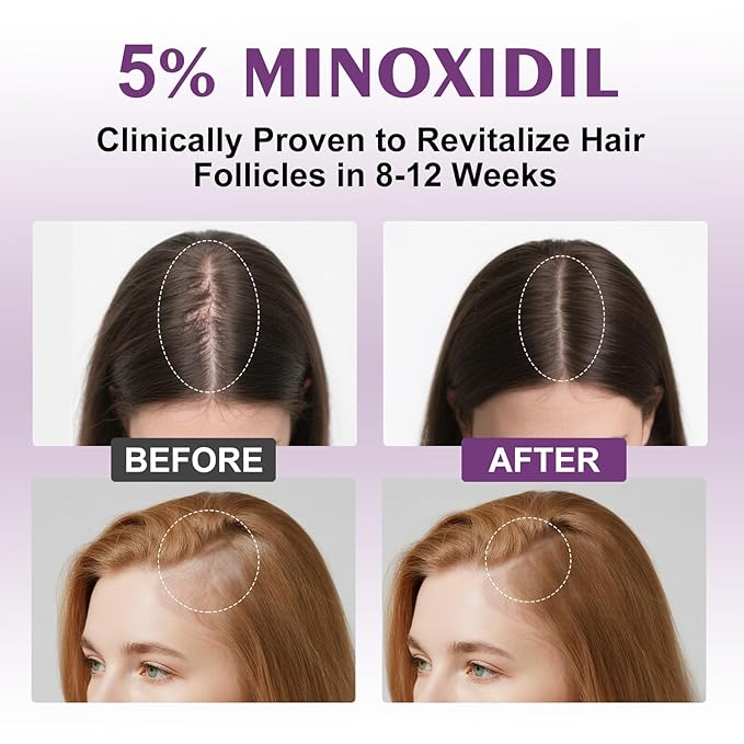 5% Minoxidil Spray for Women-Free minoxidil applicator included，monoxide for men hair Infused with Biotin, hers hair regrowth treatment, Supports Thicker and Fuller Hair & Beard (13oz, 7 Month Supply)