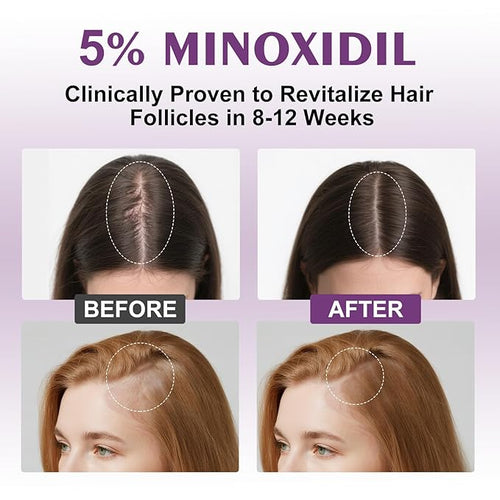 5% Minoxidil Spray for Women-Free minoxidil applicator included，monoxide for men hair Infused with Biotin, hers hair regrowth treatment, Supports Thicker and Fuller Hair & Beard (13oz, 7 Month Supply)