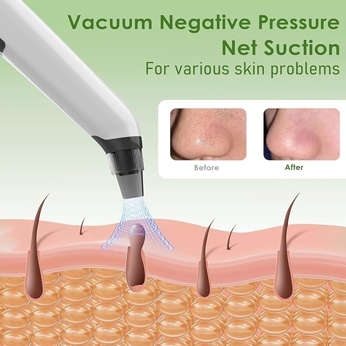 Blackhead Remover Pore Vacuum - Facial Pore Cleaner with 3 Adjustable Suction Levels, 4 Blackhead Removal Tools, Electric Acne Extractor Tool for Women & Men
