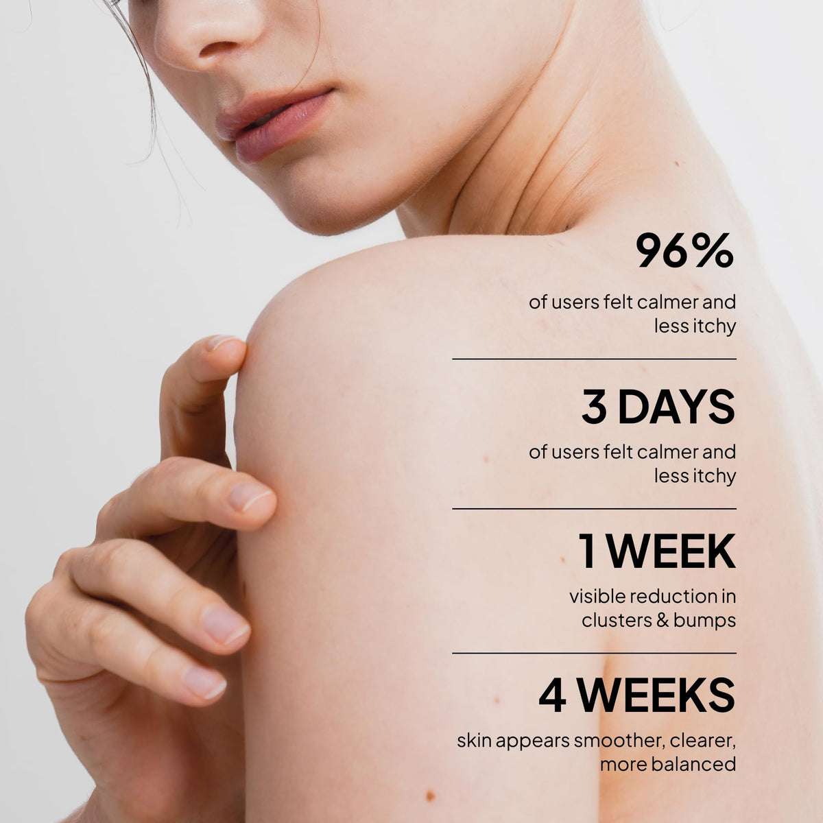BellamiLuxx Fungal Acne Treatment Lotion: Effective Face & Body Pimple Cream for Bumps, Clusters, Itch & Redness – Fungal-Prone Skin Acne Treatment Moisturizer for Teens & Adults with Natural Actives