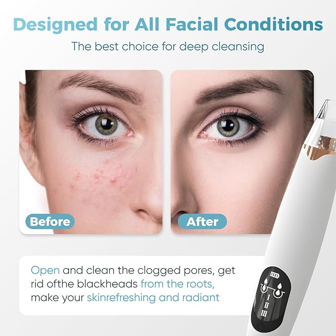 Gacavks Blackhead Remover Pore Vacuum, Electric Facial Pore Extractor with Silicone Probes & Vibration Tech, 3 Suction Levels Pore Cleaner for Facial Cleansing, USB Rechargeable