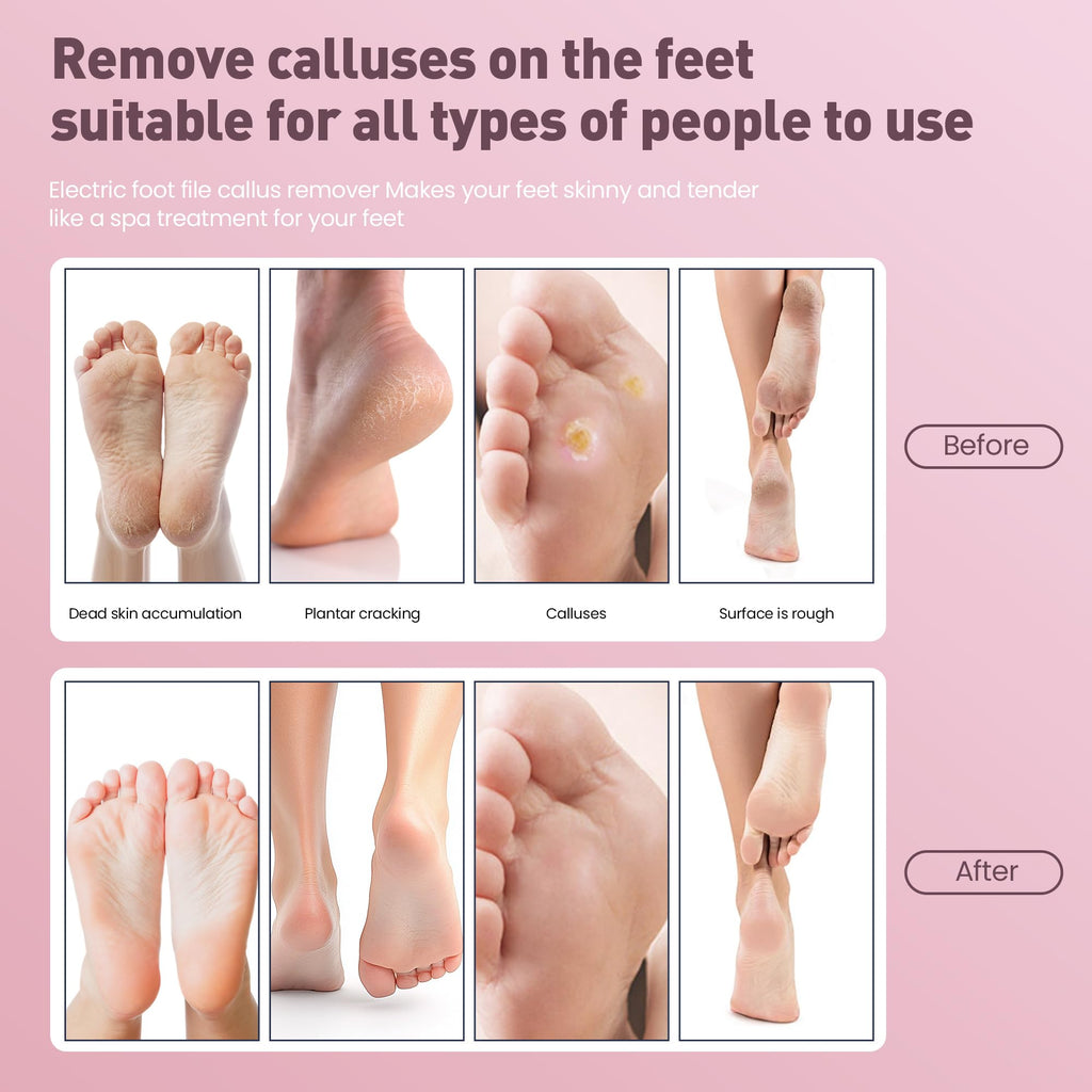 Electric Foot Callus Remover,2 in1 Rechargeable Callus Remover for Feet,9-Speed Cordless Electric Foot File Nail Grinder,Foot Scrubber Pedicure Tools for Dead Skin Dry Cracked Feet(Pink Fold)