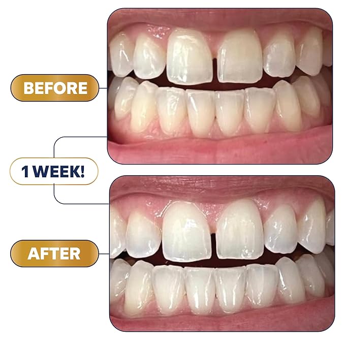 Lumineux 2-in-1 Teeth Whitening Pen, Removes Coffee & Tea Stains