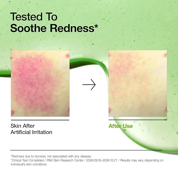 Anua Azelaic Acid 10 Hyaluron Redness Soothing Serum, Facial Serum for Blemish-Prone & Oily-Prone Skin, Lightweight & Hydrating Blemish Care, Hyaluronic Acid, Korean Skincare, 1.01 fl oz.