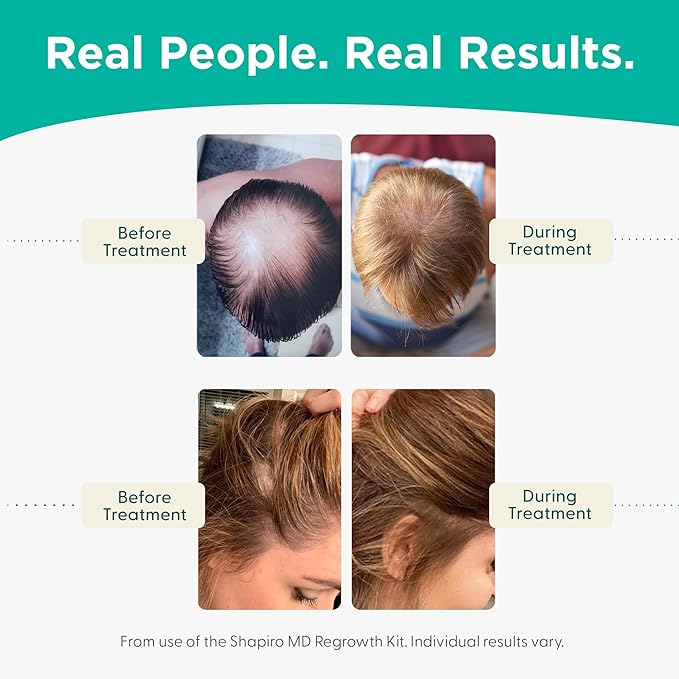 Shapiro MD Hair Growth Experts Hair Loss Shampoo and Conditioner, 1 Month