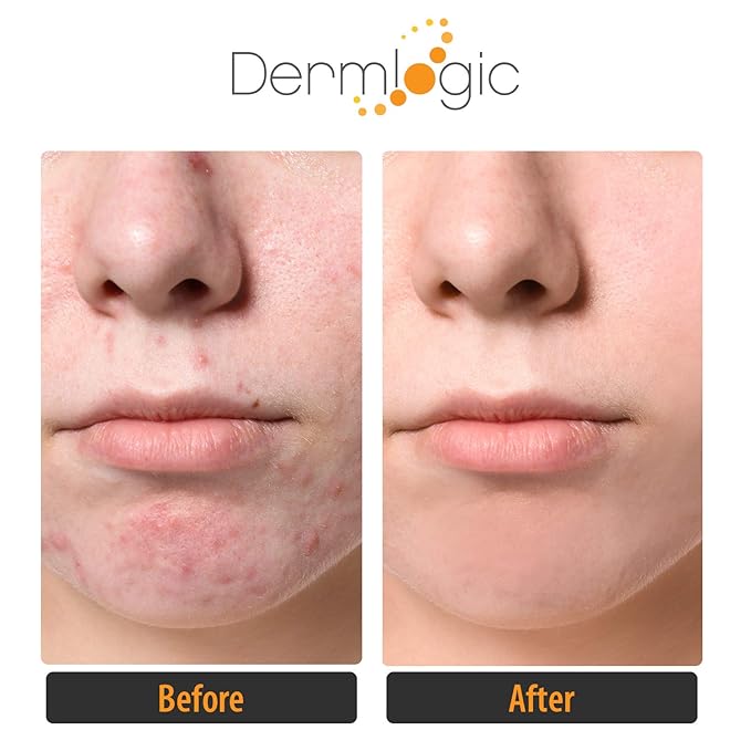 Dermlogic Acne Treatment Pads-Contains Glycolic, Lactic, Salicylic Acid. Eliminates Oily Skin, Clogged Pores & Cystic Breakouts. Removes Dark Spots, Whitehead & Blackhead Pimples for Face & Body.