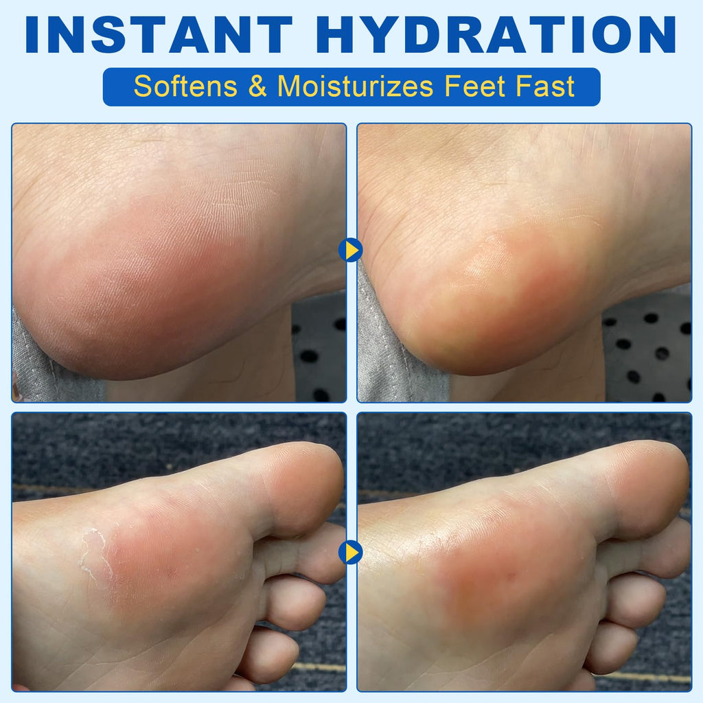 60% Urea Foot Cream, 1.41Fl Oz Foot Cream Maximum Strength Moisturizer for Dry Cracked Heels, Urea Foot Lotion Nourish Cracking Rough Dry Hands/Feet