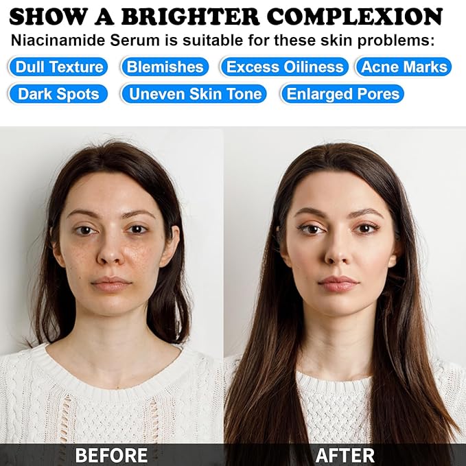 MISSEDSEN Niacinamide Serum for Face with Zinc & Hyaluronic Acid, 1 Oz