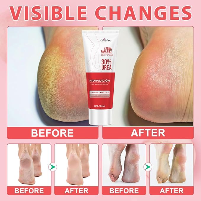 ZAIDOC Urea Cream 30 Percent for Feet 3.38 oz, Foot Cream and Hand Cream Maximum Strength with Hyaluronic Acid, Aloe Vera for Deep Moisturizes, Callus Remover