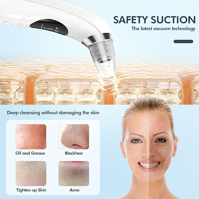 CHIMOCEE Blackhead Remover Pore Vacuum, Upgraded Black Head Remover for Face, Electric Acne Comedone Whitehead Extractor Tools-5 Suction Power, 5 Probes, USB Rechargeable Pimple Popper Tool Kit