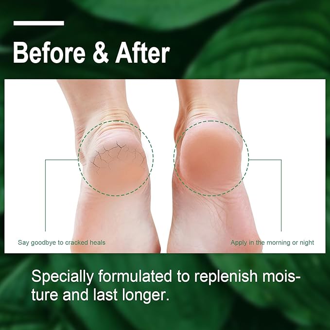 LEBARED Urea Cream 40 Percent For Feet Maximum Strength, Plus 2% Salicylic Acid with Hyaluronic Acid, Urea Foot & Hand Cream for Dry Cracked, 4.6 oz