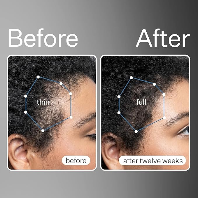 Act+ Acre, Mini Stem Cell Scalp Serum, Reduces Shedding, 3pk