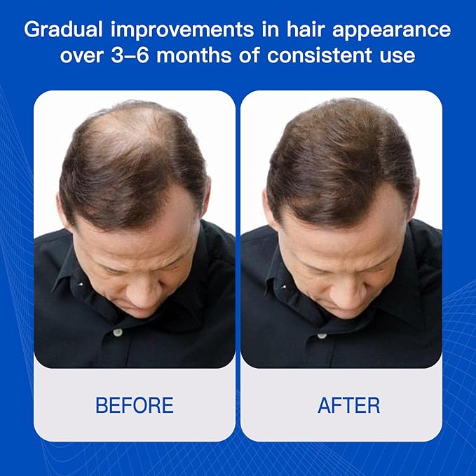 Rosemary Growth Serum with Redensyl and Anagain – Roll On 25 ml, Thicker & Stronger Strands, Helps Reduce Fall & Stimulates Follicles, Supports Volume for All Types