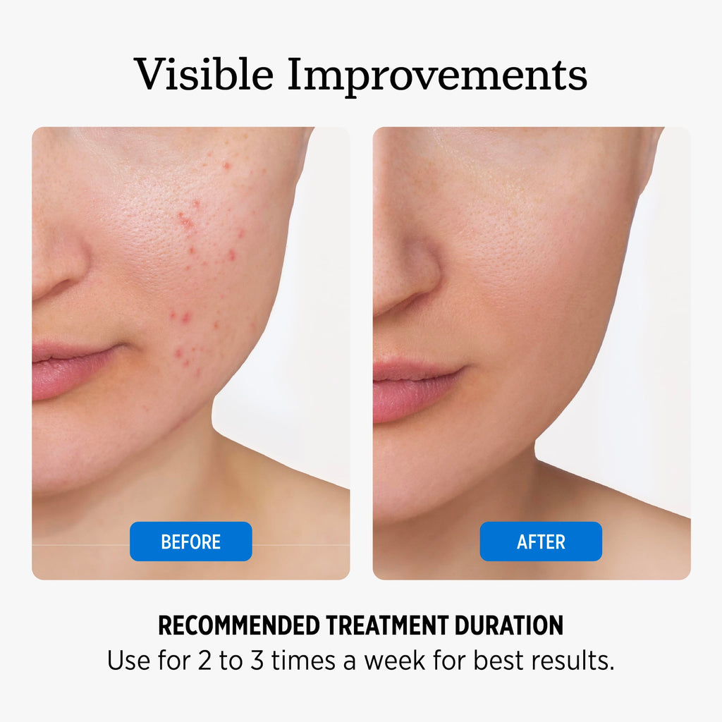 NUVADERMIS 35% Glycolic Acid Peel Pads – Exfoliating Facial Resurfacing for Blackheads, Dark Spots, and Acne – Safe for Sensitive Skin – 60 Double-Sided Pads
